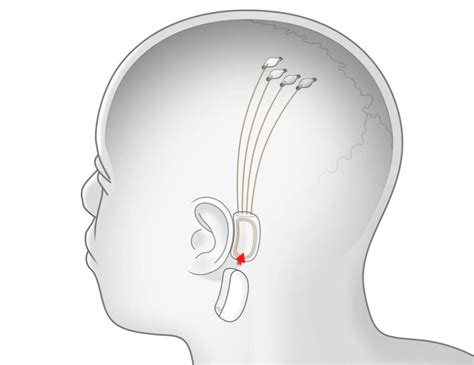 How Much Will Neuralink Cost 2024?