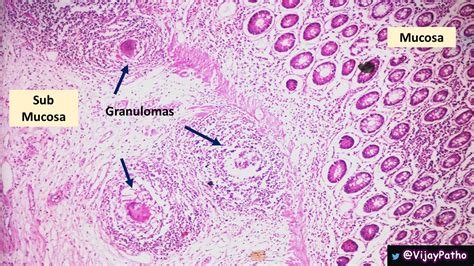 Intestinal Tuberculosis - Pathology Made Simple