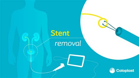 Challenges around Double-J stent removal - Coloplast Urology