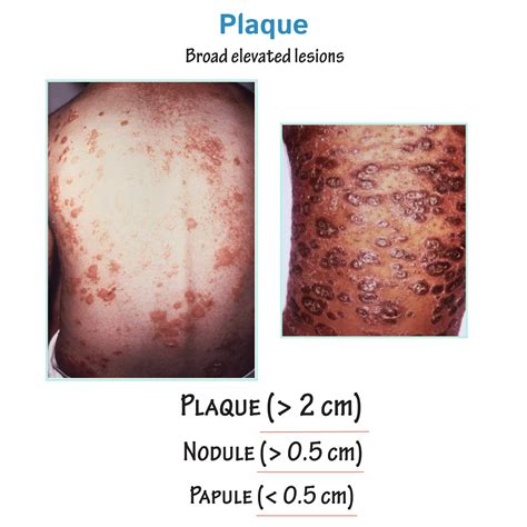 Clinical Pathology Glossary: Plaque | ditki medical & biological sciences