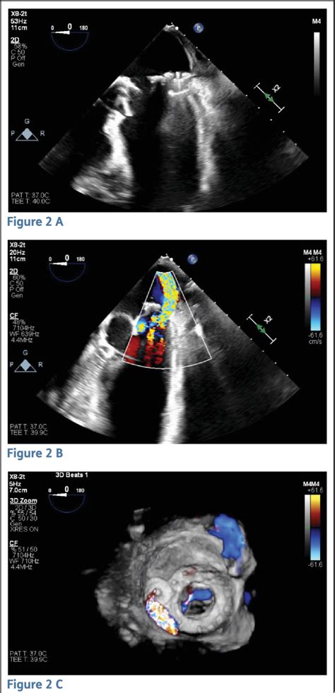 Figure 2 from Percutaneous Management of Bioprosthetic Mitral Valve Dehiscence with Combined ...