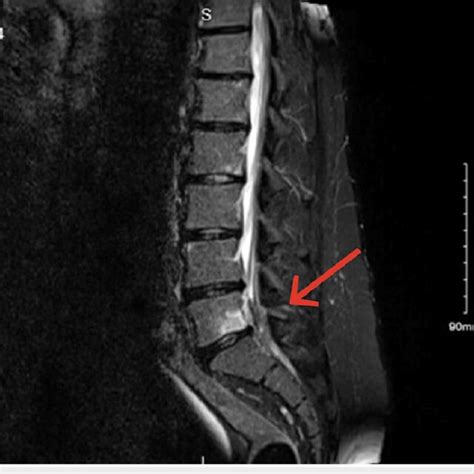 MRI revealed a paracentral left disc herniation at the L5-S1 level,... | Download Scientific Diagram