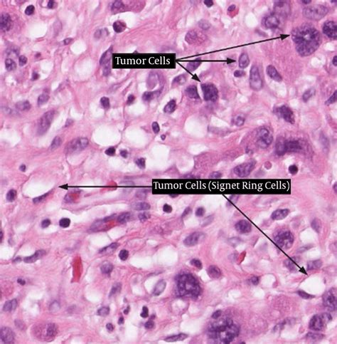 Cancer Cell Histology