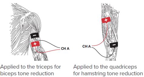 Electrotherapy for the Management of Hypertonia