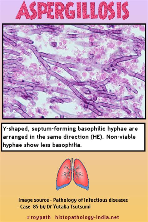 Aspergillus fumigatus is the species most frequently isolated from ...