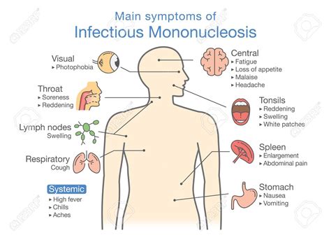 Causas De Mononucleosis Infecciosa | My XXX Hot Girl