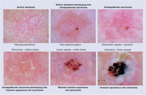 Stages Of Actinic Keratosis | My XXX Hot Girl