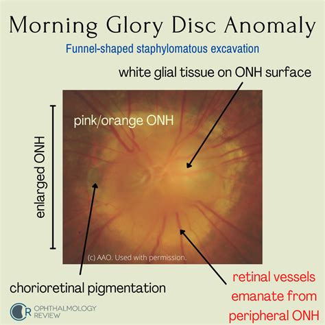 Morning Glory Disc Anomaly — Ophthalmology Review