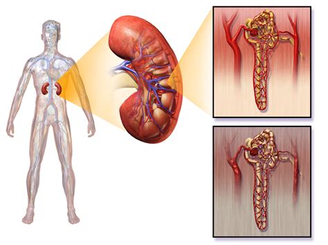 Diabetic Nephropathy