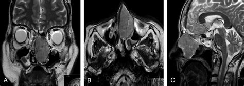 Meningioma Arising From the Anterior Skull Base and Filling ...