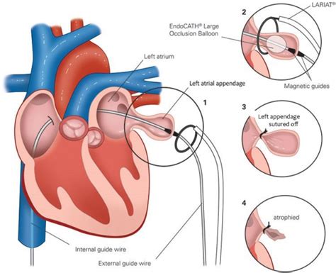 Left Atrial Appendage Closure Procedure