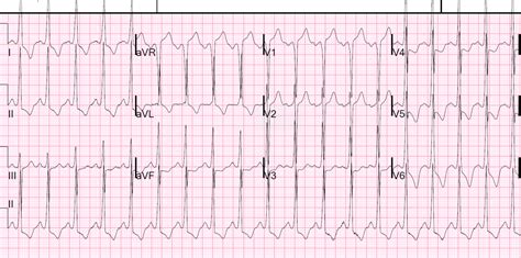 Dr. Smith's ECG Blog: History of Hypertrophic Cardiomyopathy (HOCM ...