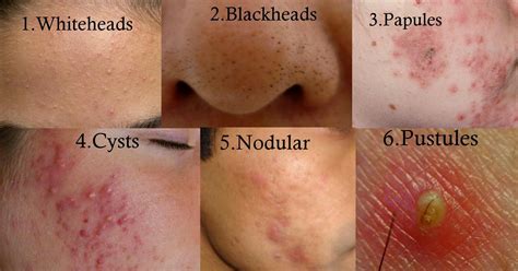 Types of Acne | Back acne treatment, Acne vulgaris, Diy acne treatment