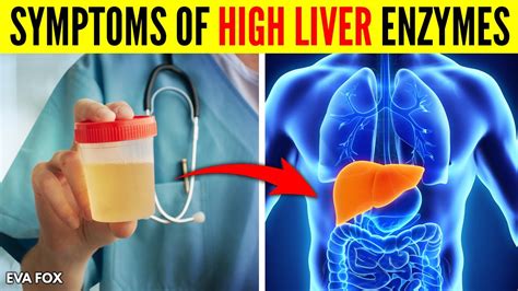 Signs and Symptoms of High Liver Enzymes Causes and Treatment - YouTube