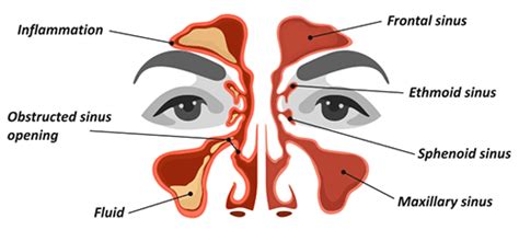 Sinusitis (Sinus Infection) Symptoms and Treatment