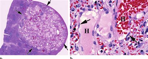 Splenic hemangioma. (a) Photomicrograph (original magnification, 4; H-E... | Download Scientific ...