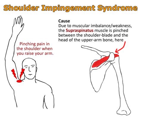 Shoulder impingement syndrome treatment with 4 exercises – Artofit