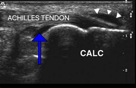 Ultrasound Images Of Insertional Achilles Tendinopathy Ankle, Foot And Orthotic Centre | atelier ...