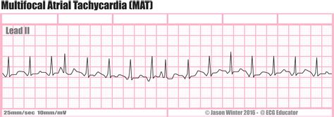 ECG Educator Blog : Multifocal Atrial Pacemaker (MAT)