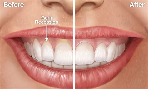 Understanding Gum Recession Eden Prairie MN | PerioWest