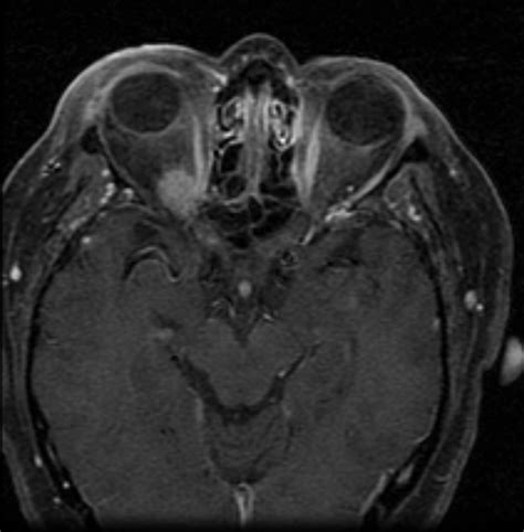 Meningiomas: A case and a review