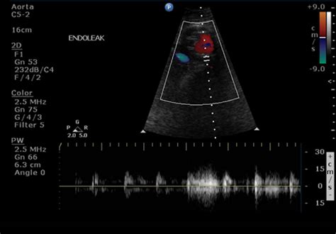 Late type II endoleaks after endovascular aneurysm repair require ...