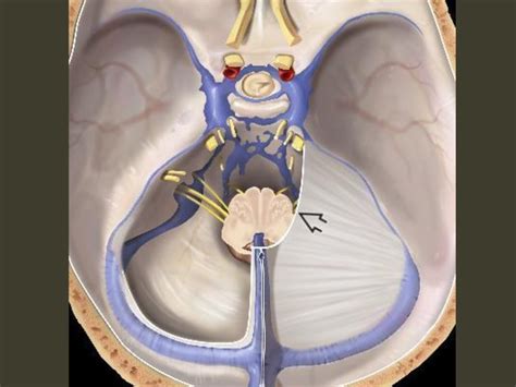 Brain herniation imaging