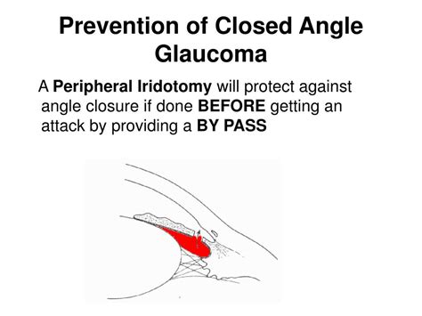 PPT - ACUTE ANGLE CLOSURE GLAUCOMA PowerPoint Presentation, free download - ID:671613