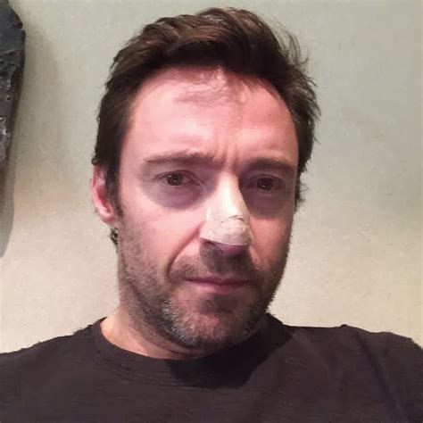 NOTHING PERSONAL: Actor Hugh Jackman reveals skin cancer scare on Instagram