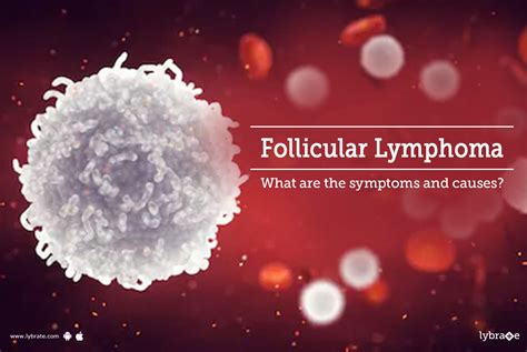 Follicular Lymphoma - What are the symptoms and causes? - By Dr. Garima | Lybrate