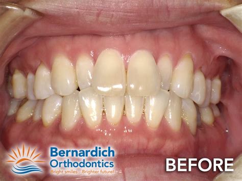 Invisalign Before and After Images | Allentown Bethlehem PA Lehigh ...