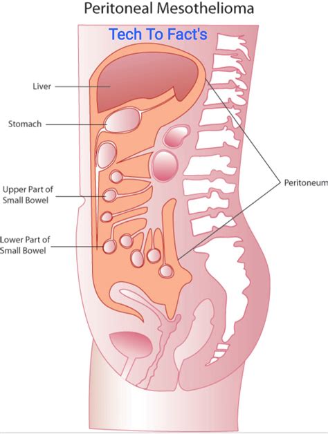 What is Peritoneal Mesothelioma?