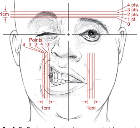 Figure 6 from Neuroanatomical correlation of the House-Brackmann grading system in the ...