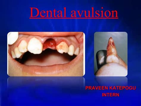 Replantation of Avulsed Permanent Anterior Teeth: A Case Report.