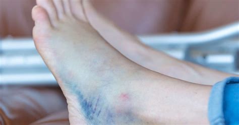 Bruised heel remedies and when to see a doctor