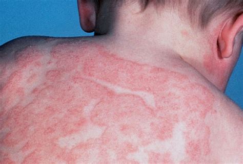 Atopic Dermatitis Causes, Symptoms | Homeopathic Treatment