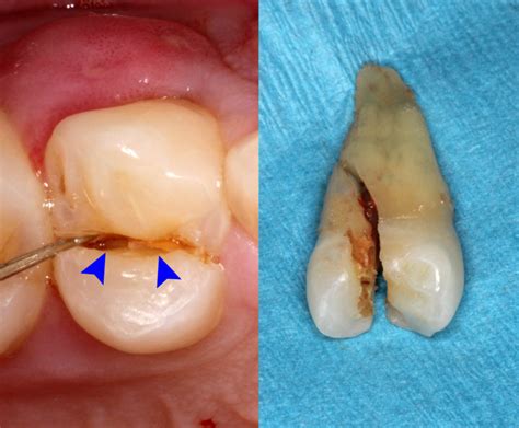 Cracked Tooth Syndrome (CTS). Do you have one? - DentalDost