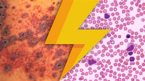 Itp Thrombocytopenia