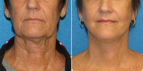 How Much Does a Neck Lift Cost? | Torrance Neck Lift | Awaken Aesthetics