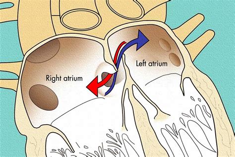 Foramen Oval Permeable y Buceo - Buceo Pedreña tu Centro de Buceo