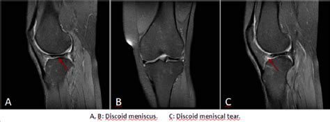 Figure 2 from MRI OF THE KNEE: normal and abnormal findings | Semantic ...