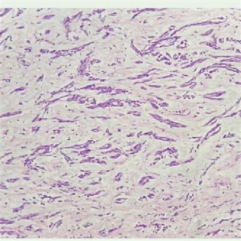 Epithelioid hemangioendothelioma composed of chains and cords of ...