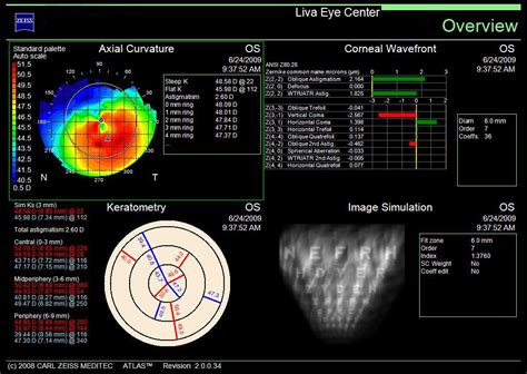 Corneal Topography - Liva Eye Center