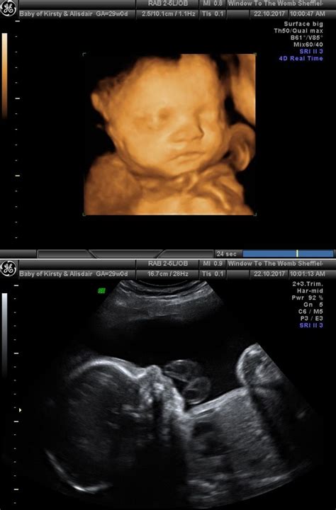 3d Ultrasound, Baby F, Womb, Sheffield, Real Time, Scan, Window, Surface, Windows