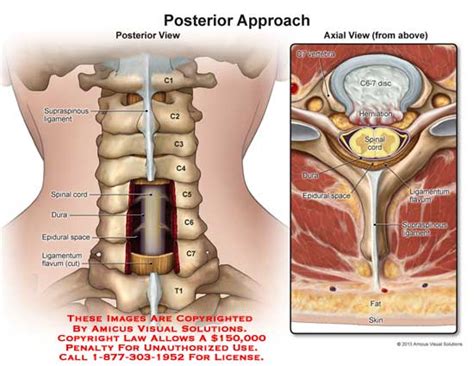 AMICUS Illustration of amicus,injury,C1,C2,C3,C4,C5,C6,C7,T1,T2 ...