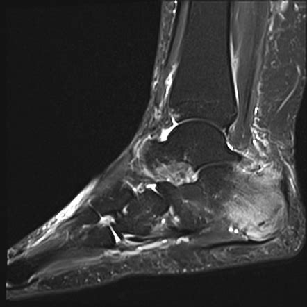 Calcaneal stress fracture | Radiology Case | Radiopaedia.org