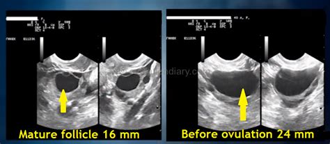 Ultrasound scanning of ovulation - Folliculometry (+ Photo ...