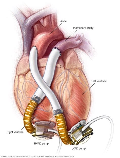 Ventricular assist device (VAD) - Drugs.com