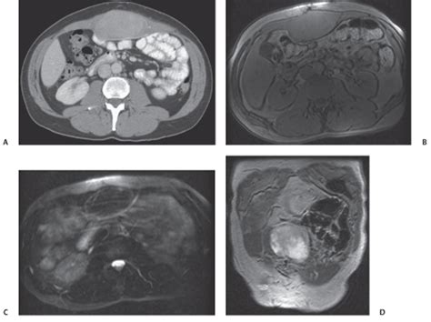 117 Anterior Abdominal Wall Desmoid Tumor | Radiology Key