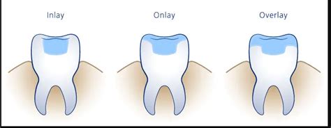 WHAT ARE DENTAL FILLING, INLAY, ONLAY, AND OVERLAY? - Xdent Center